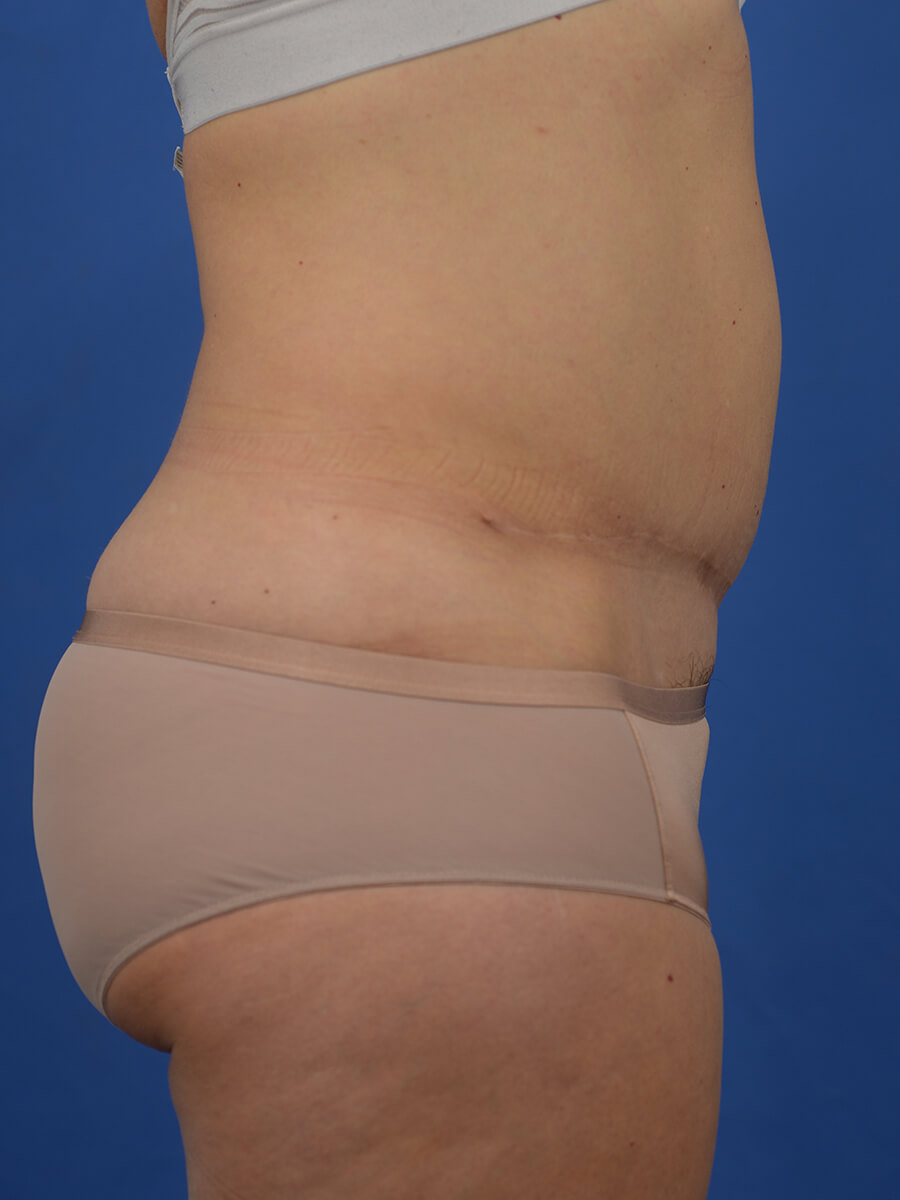 Case--8246 | After Abdominoplasty 4