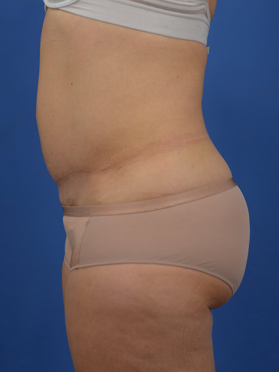 Case--8246 | After Abdominoplasty 5