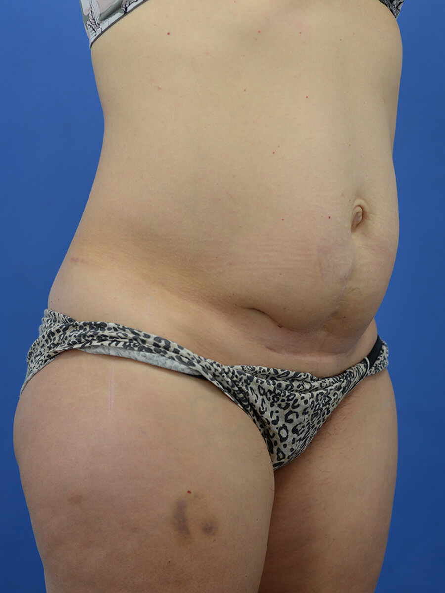 Case--8246 | Before Abdominoplasty 2