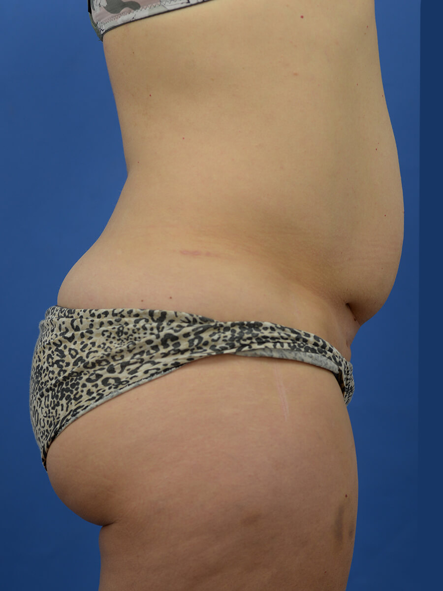 Case--8246 | Before Abdominoplasty 4