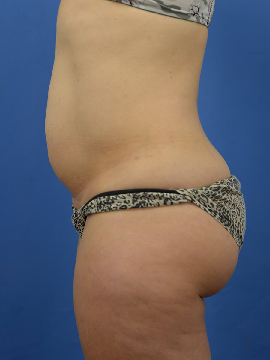 Case--8246 | Before Abdominoplasty 5
