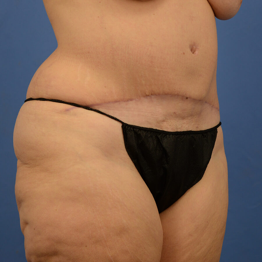 Case--7491 | After Abdominoplasty 2