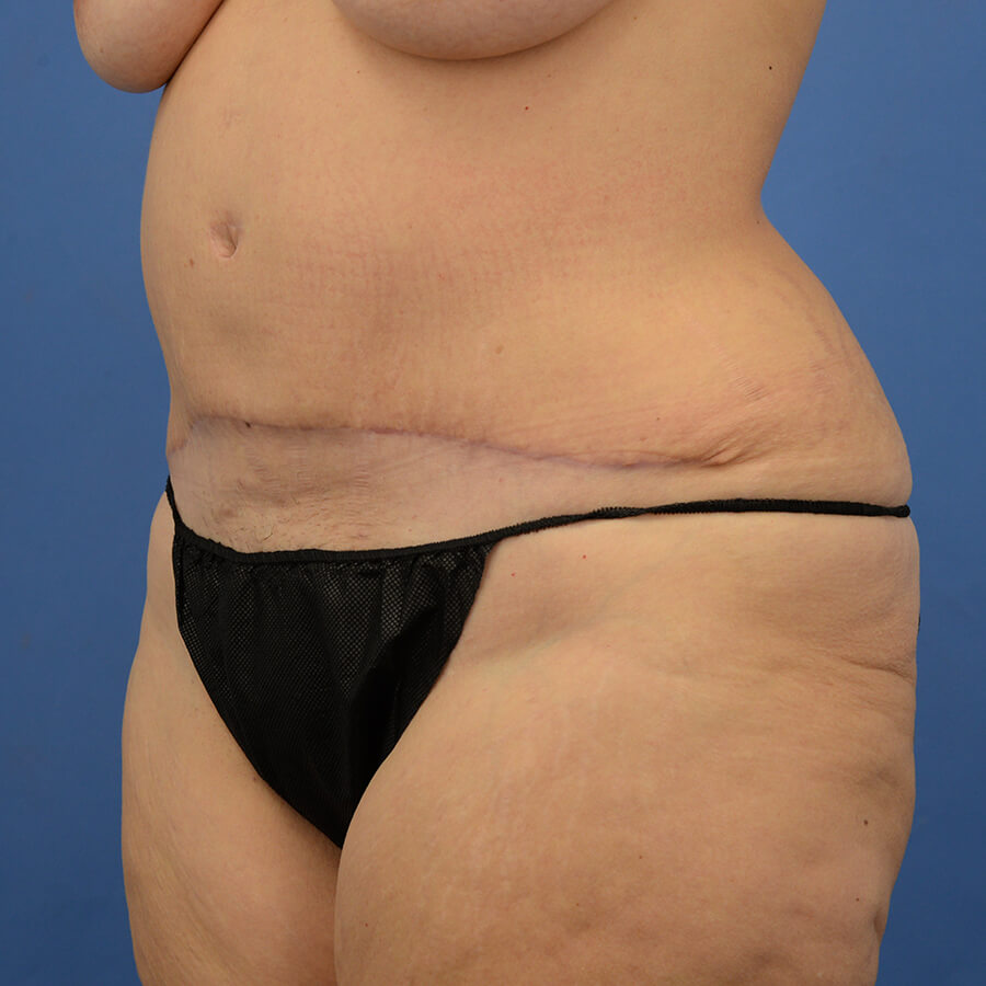 Case--7491 | After Abdominoplasty 4