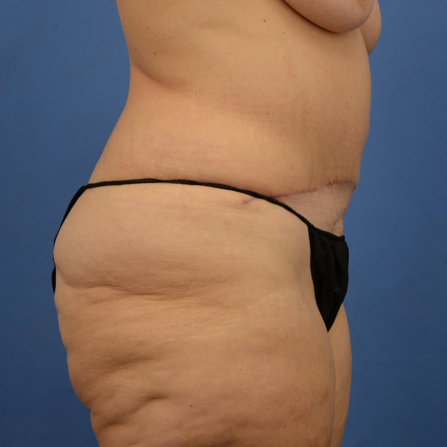 Case--7491 | After Abdominoplasty 3