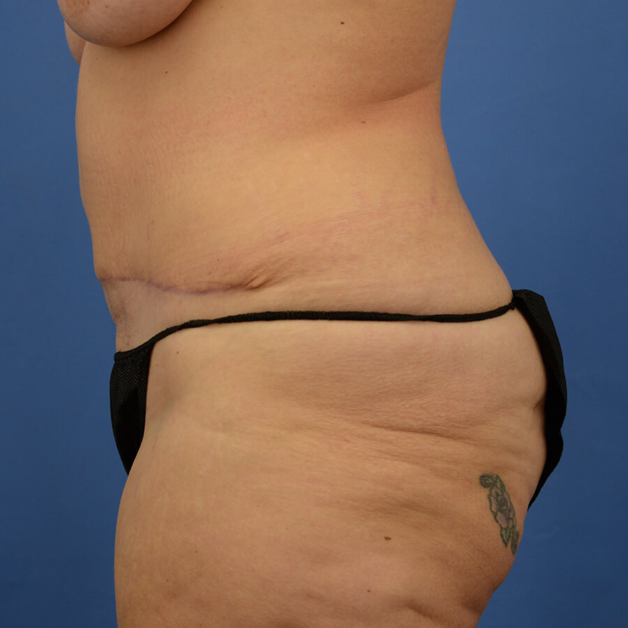 Case--7491 | After Abdominoplasty 5