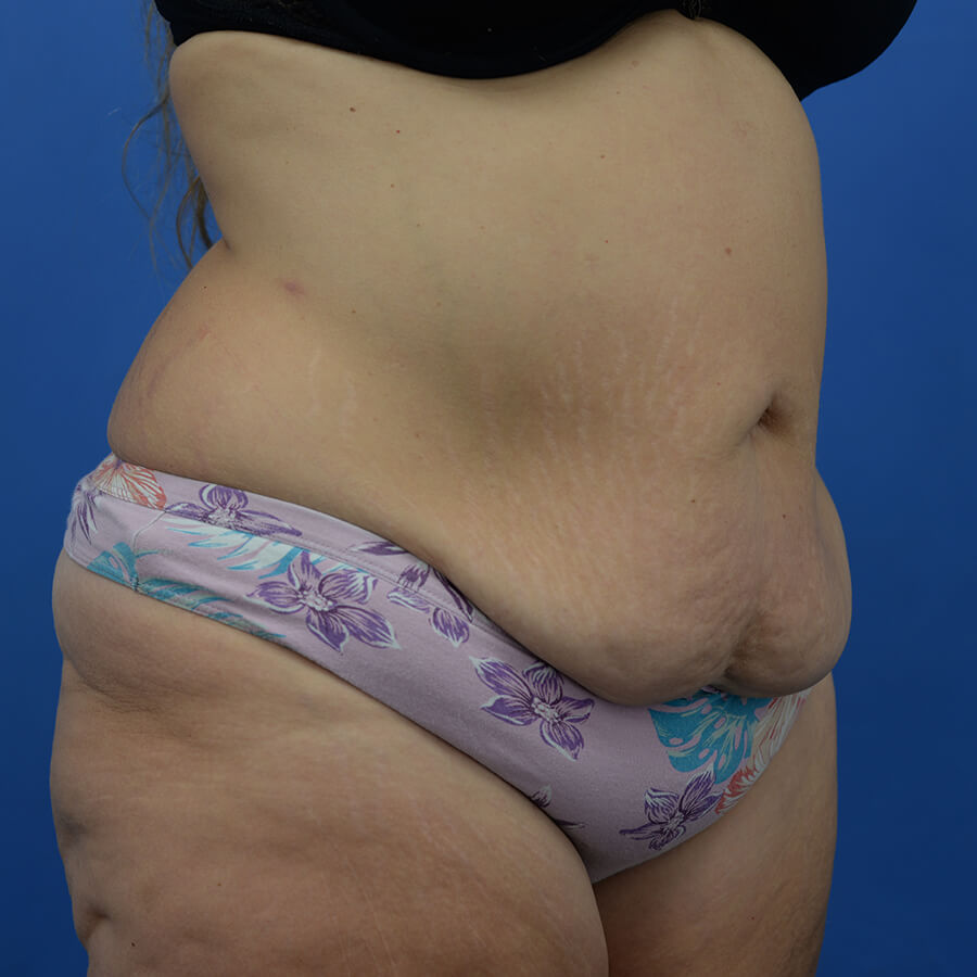 Case--7491 | Before Abdominoplasty 2