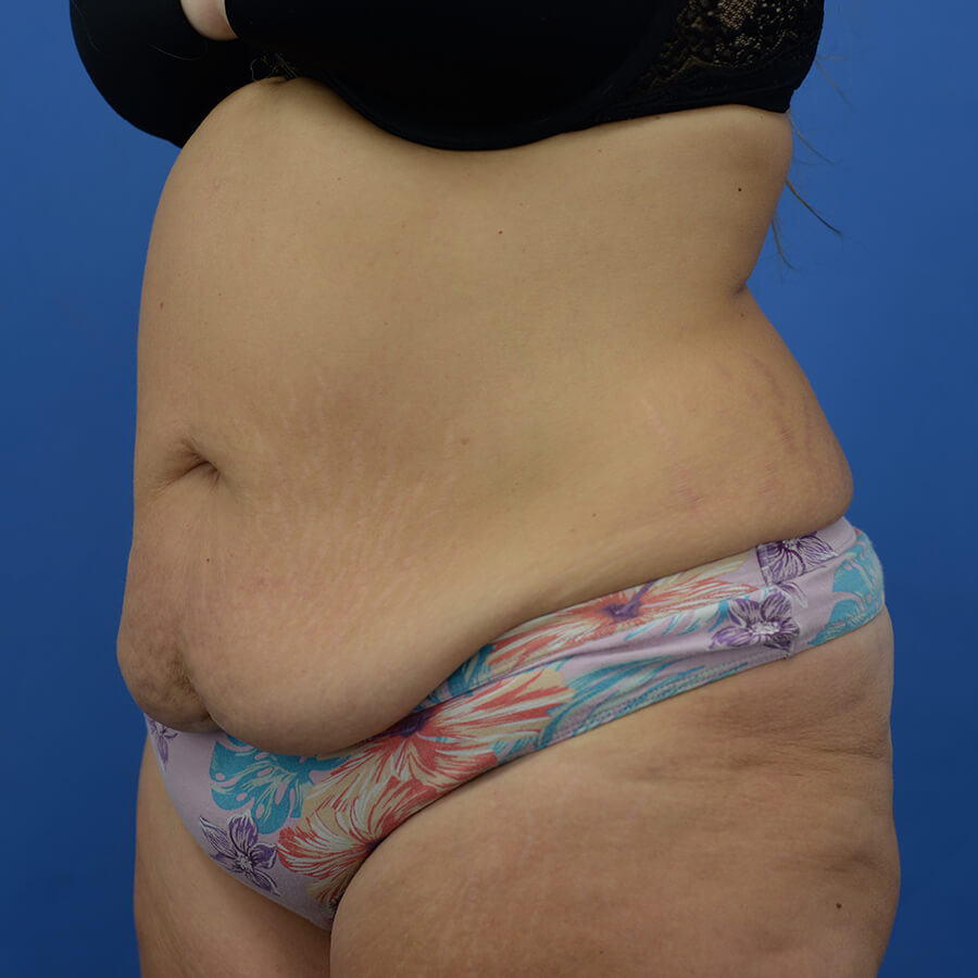 Case--7491 | Before Abdominoplasty 4