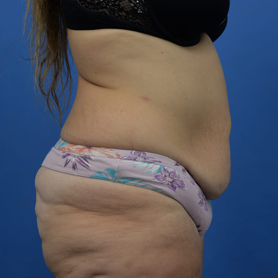 Case--7491 | Before Abdominoplasty 3