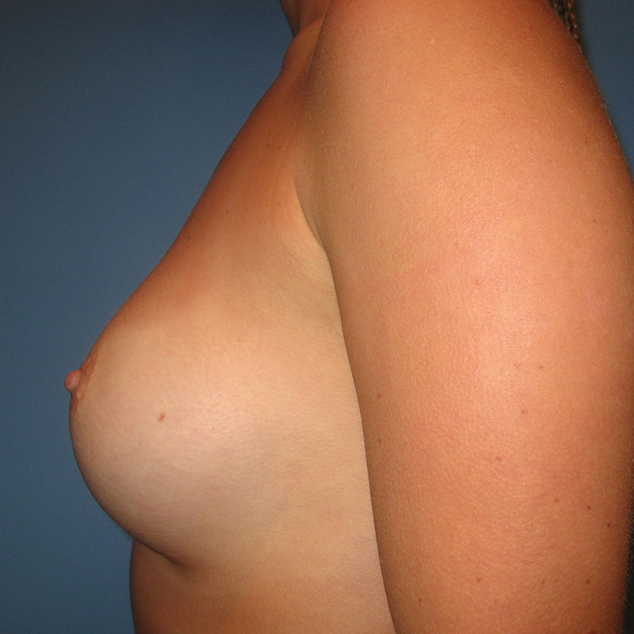 Case--8032 | After Breast Augmentation 4