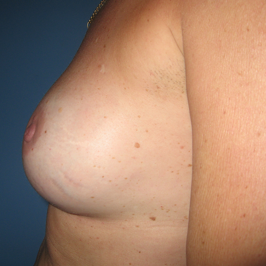 Case--6222 | After Breast Augmentation 4