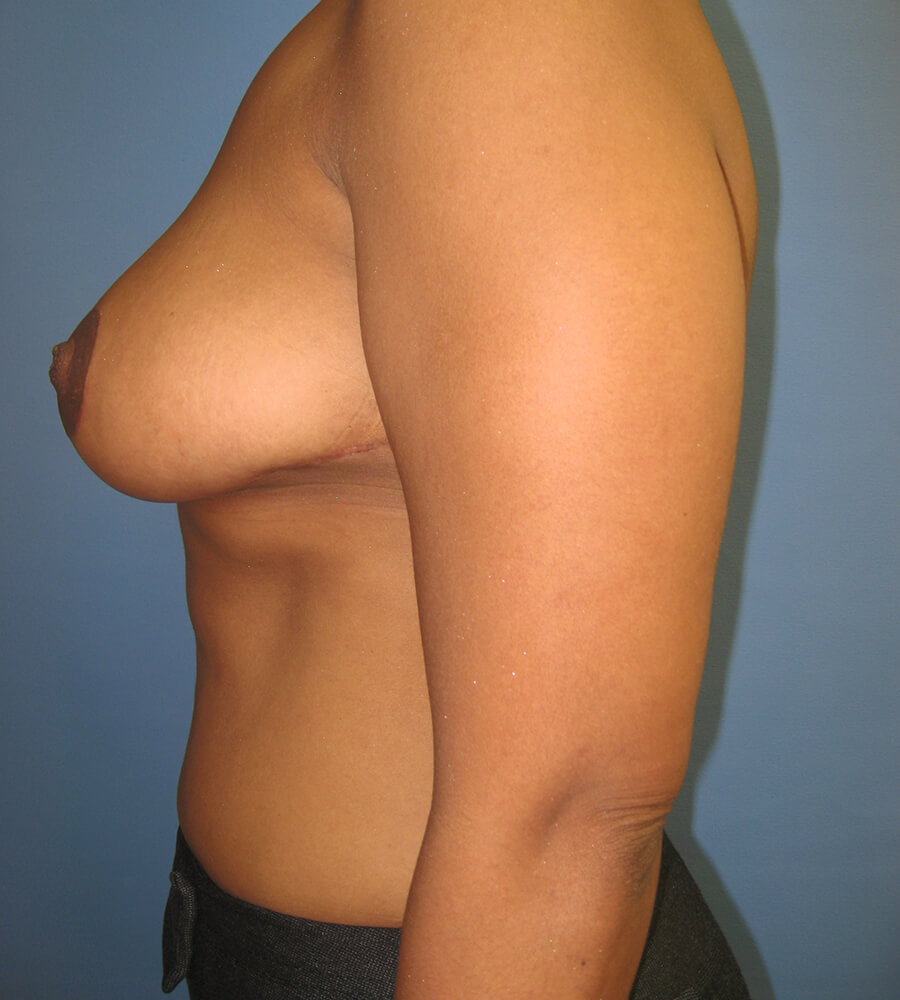 Case--7838 | After Breast Reduction 5