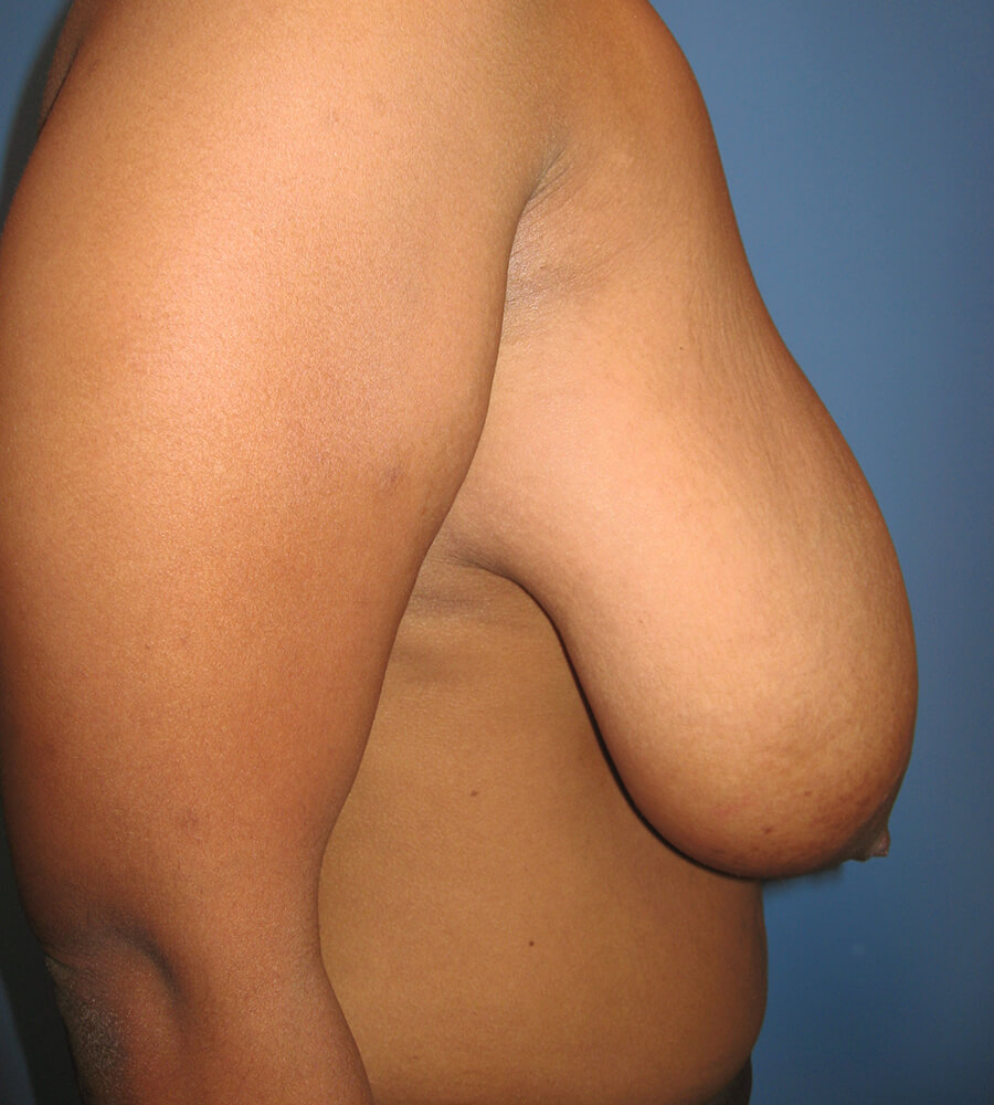 Case--7838 | Before Breast Reduction 3