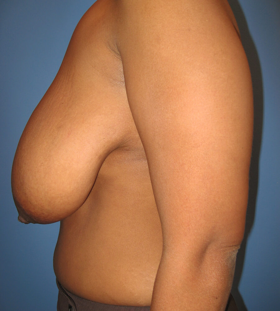 Case--7838 | Before Breast Reduction 5