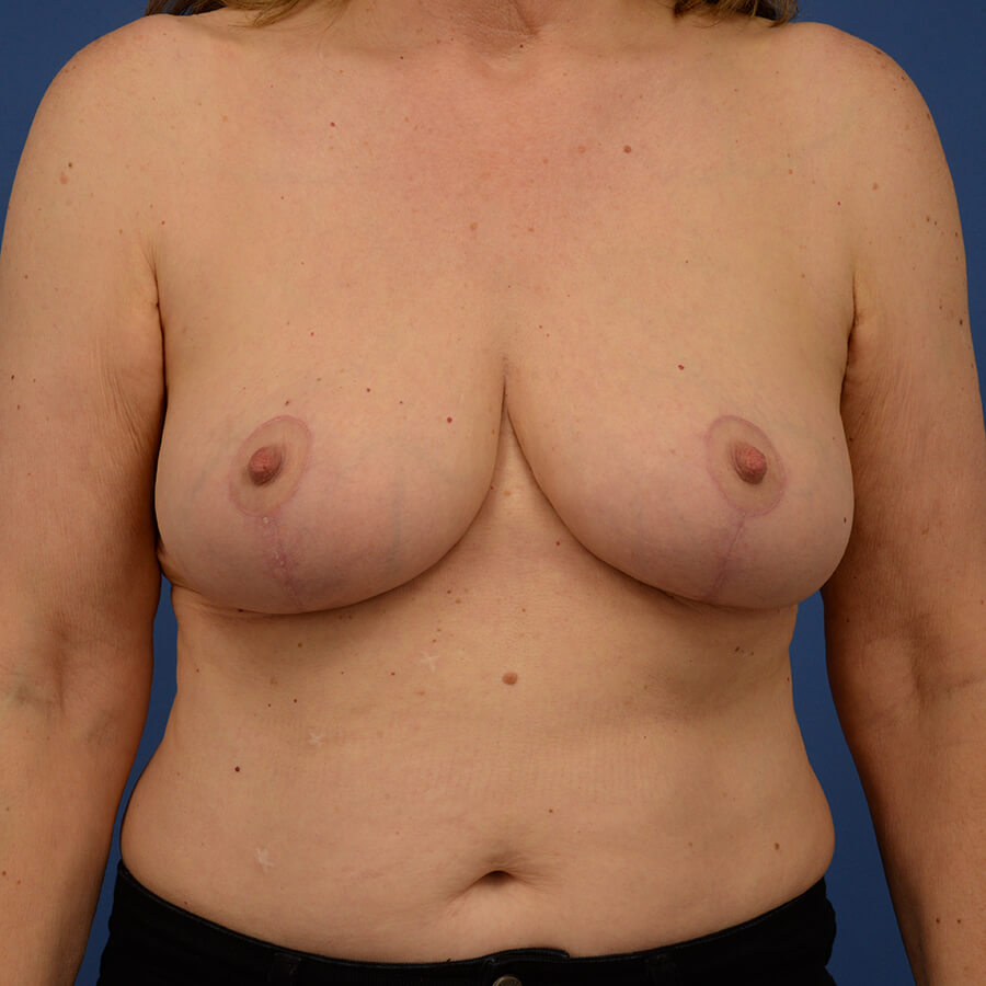 Case--7776 | After Breast Reduction 1