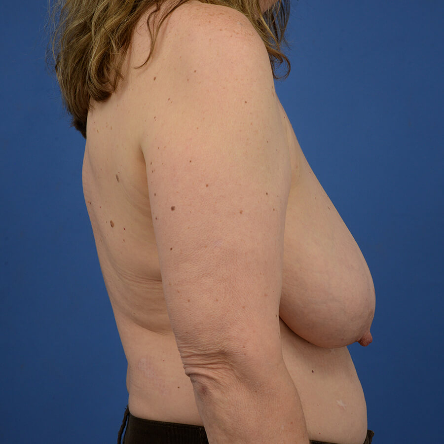 Case--7776 | Before Breast Reduction 5