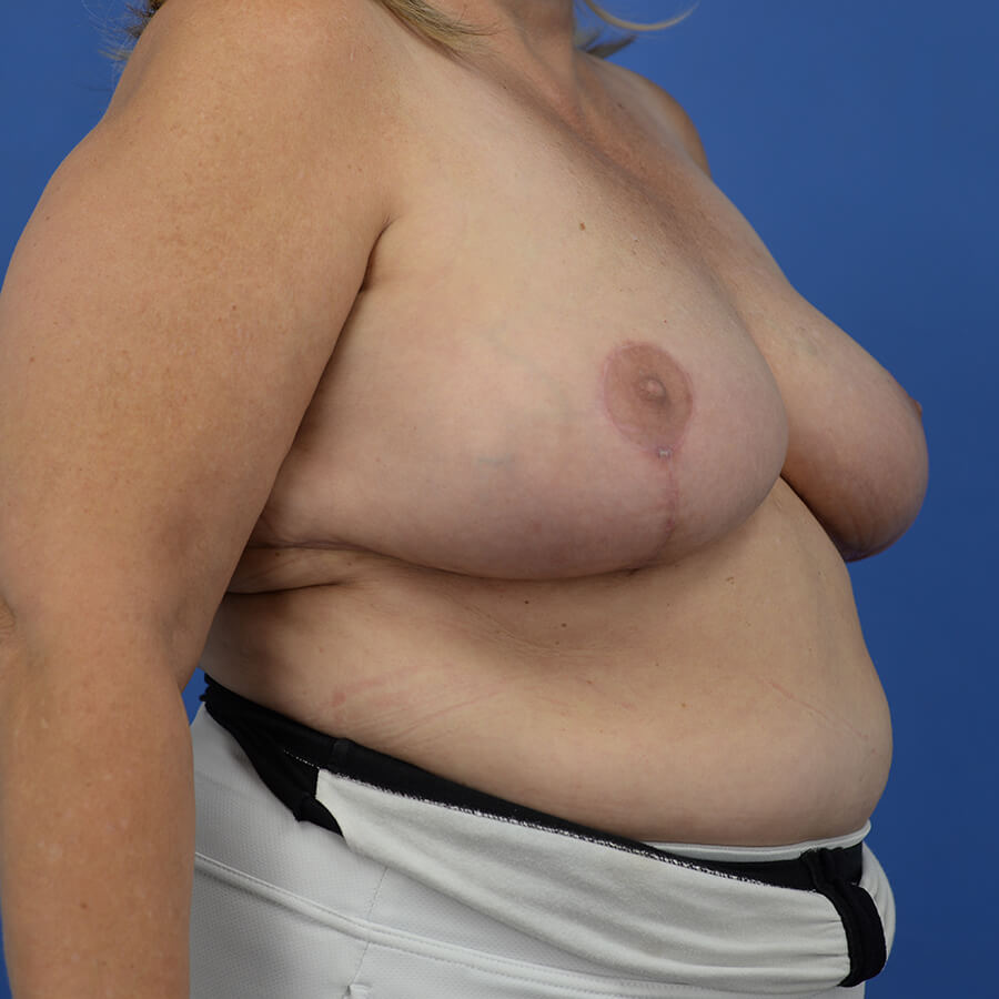 Case--3980 | After Breast 2