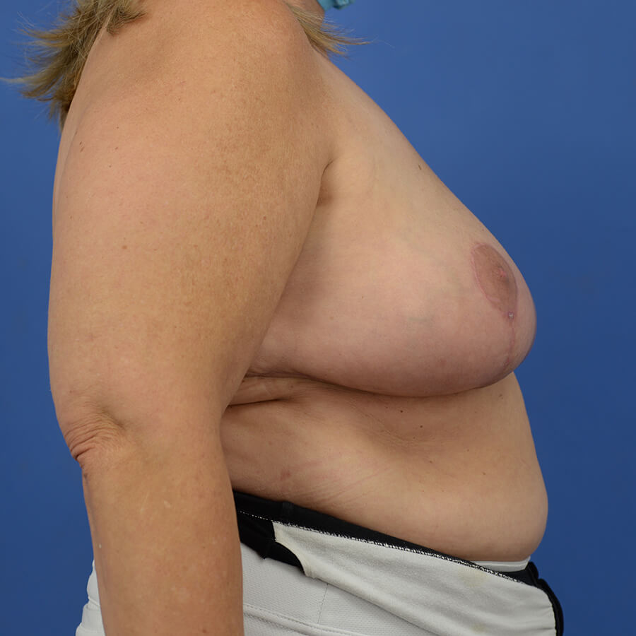 Case--3980 | After Breast 3