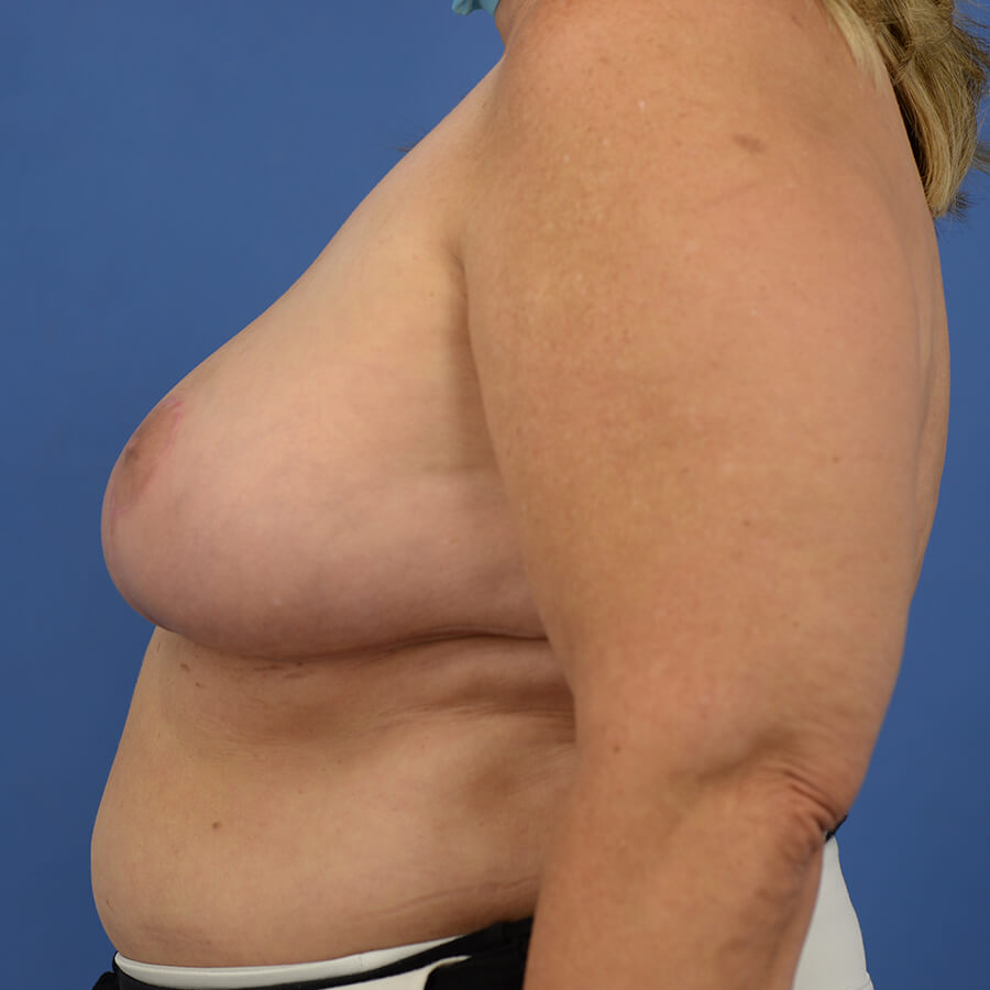 Case--3980 | After Breast 5