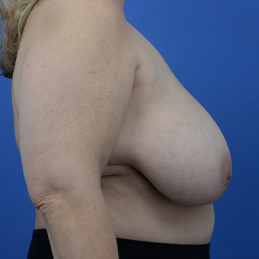 Case--3980 | Before Breast 3