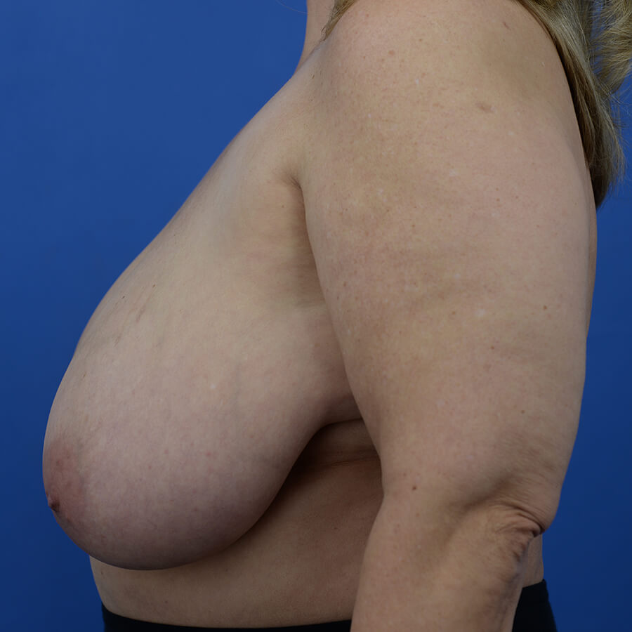 Case--3980 | Before Breast 5