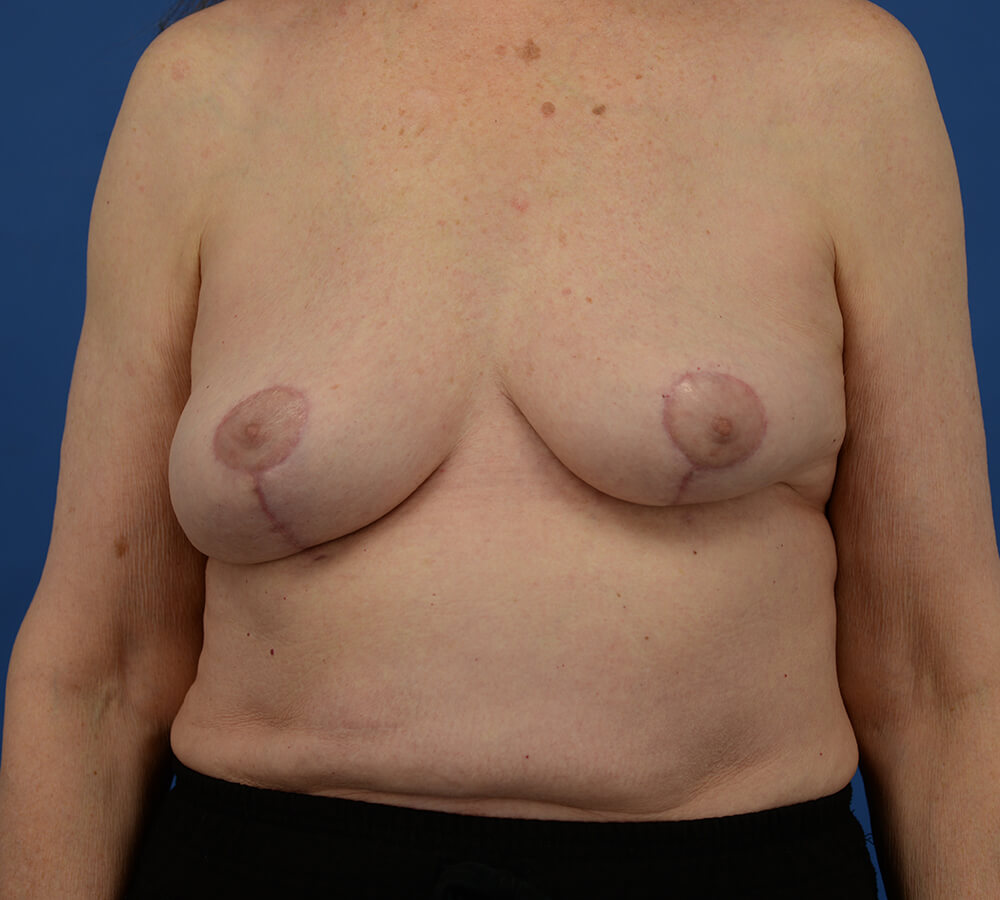 Case--2079 | After  1