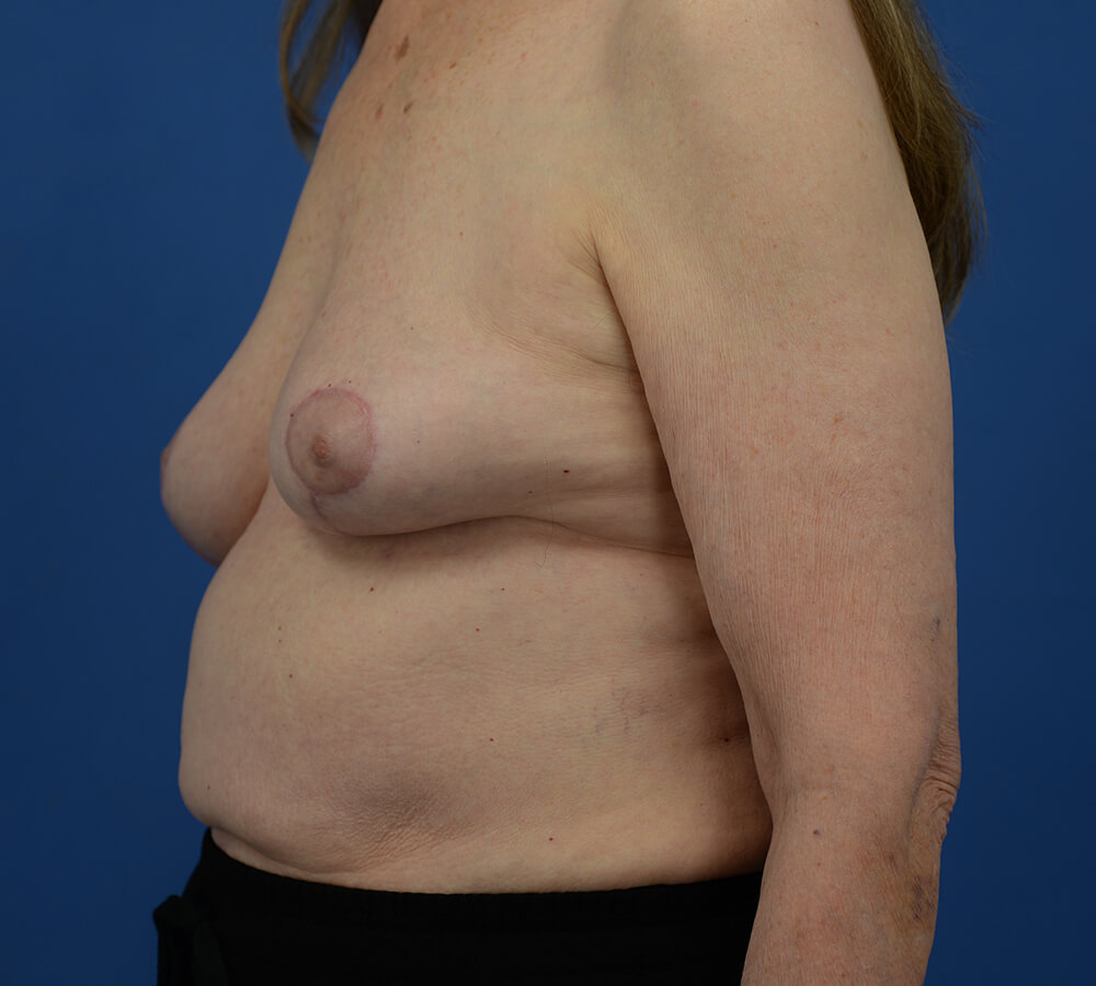 Case--2079 | After  2