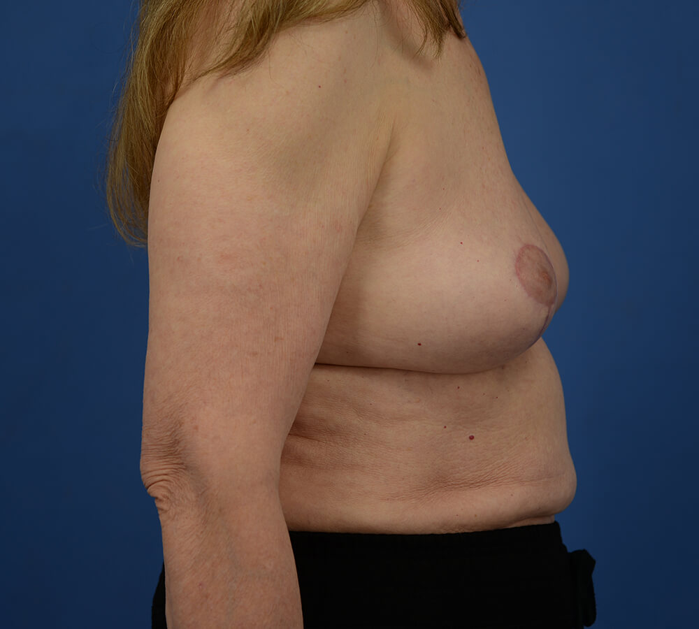 Case--2079 | After  5