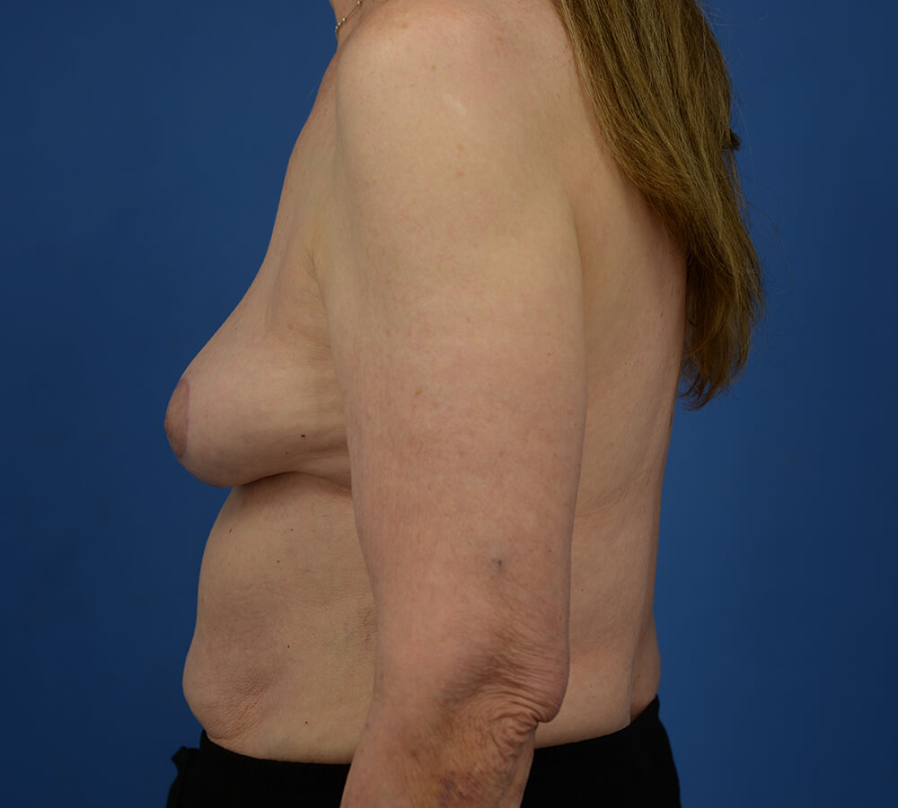 Case--2079 | After  3