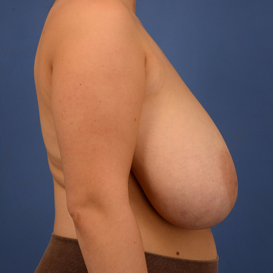 Case--5893 | Before Breast 5