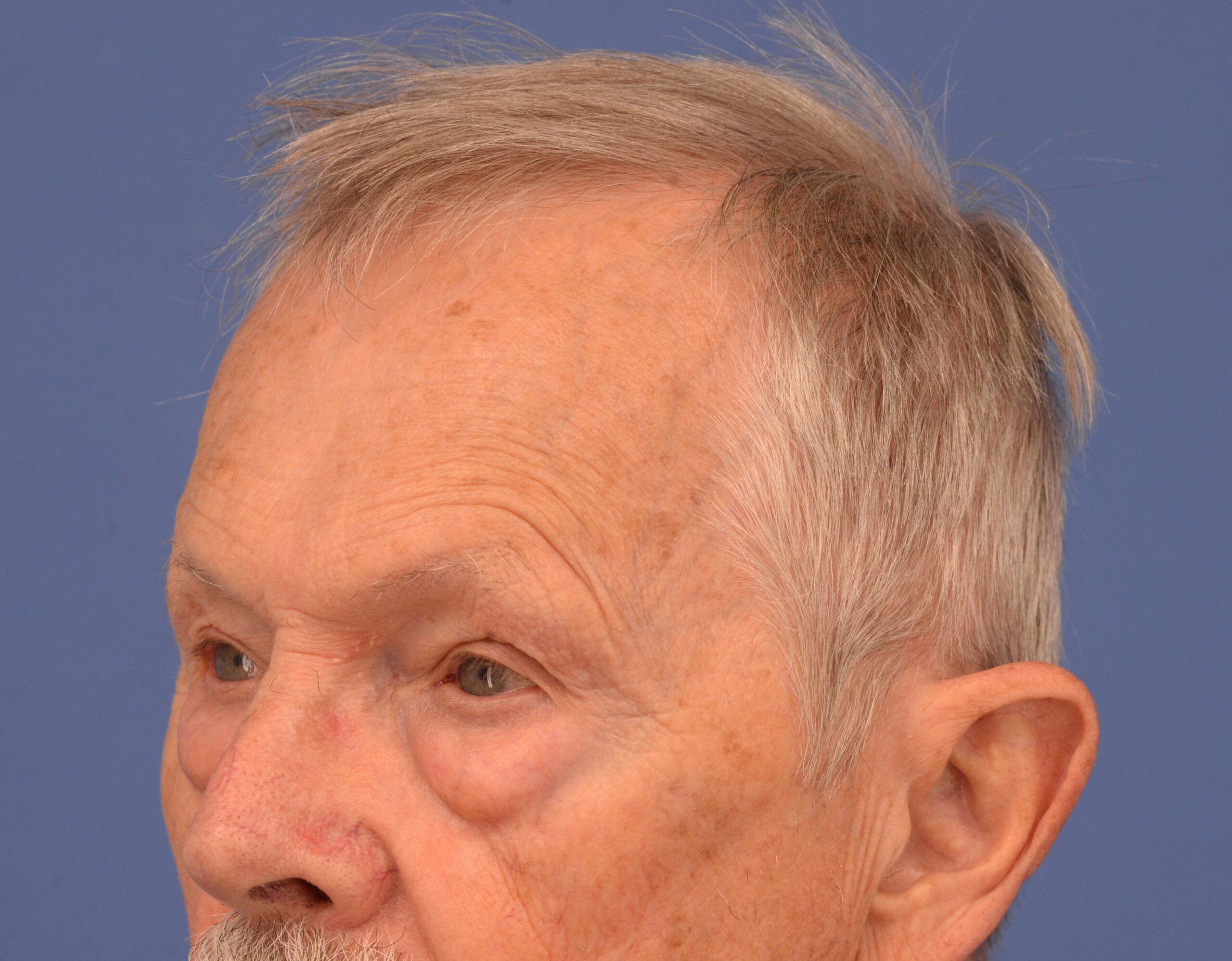 Case--7598 | Before Lower Blepharoplasty 3
