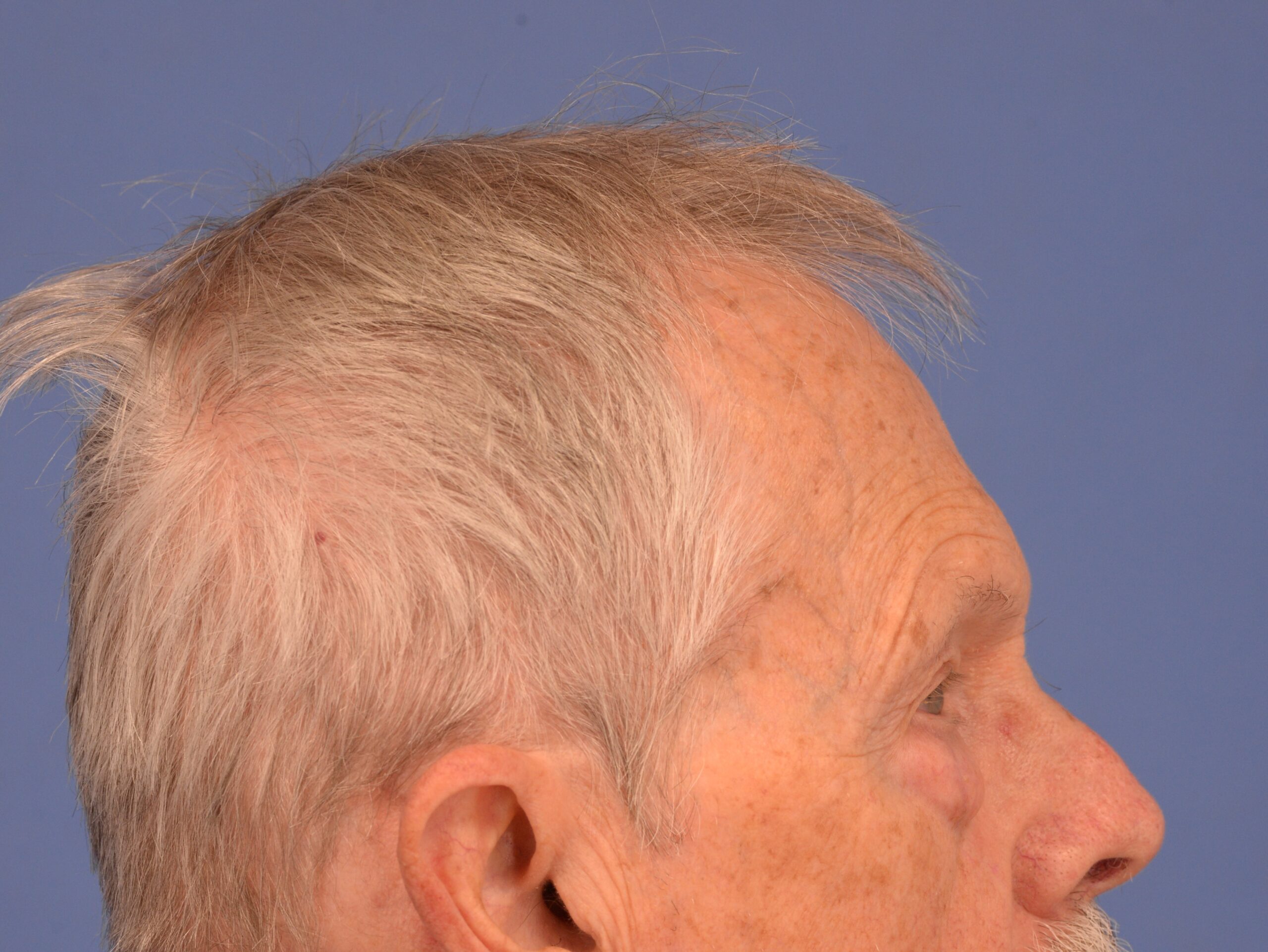 Case--7598 | Before Lower Blepharoplasty 4