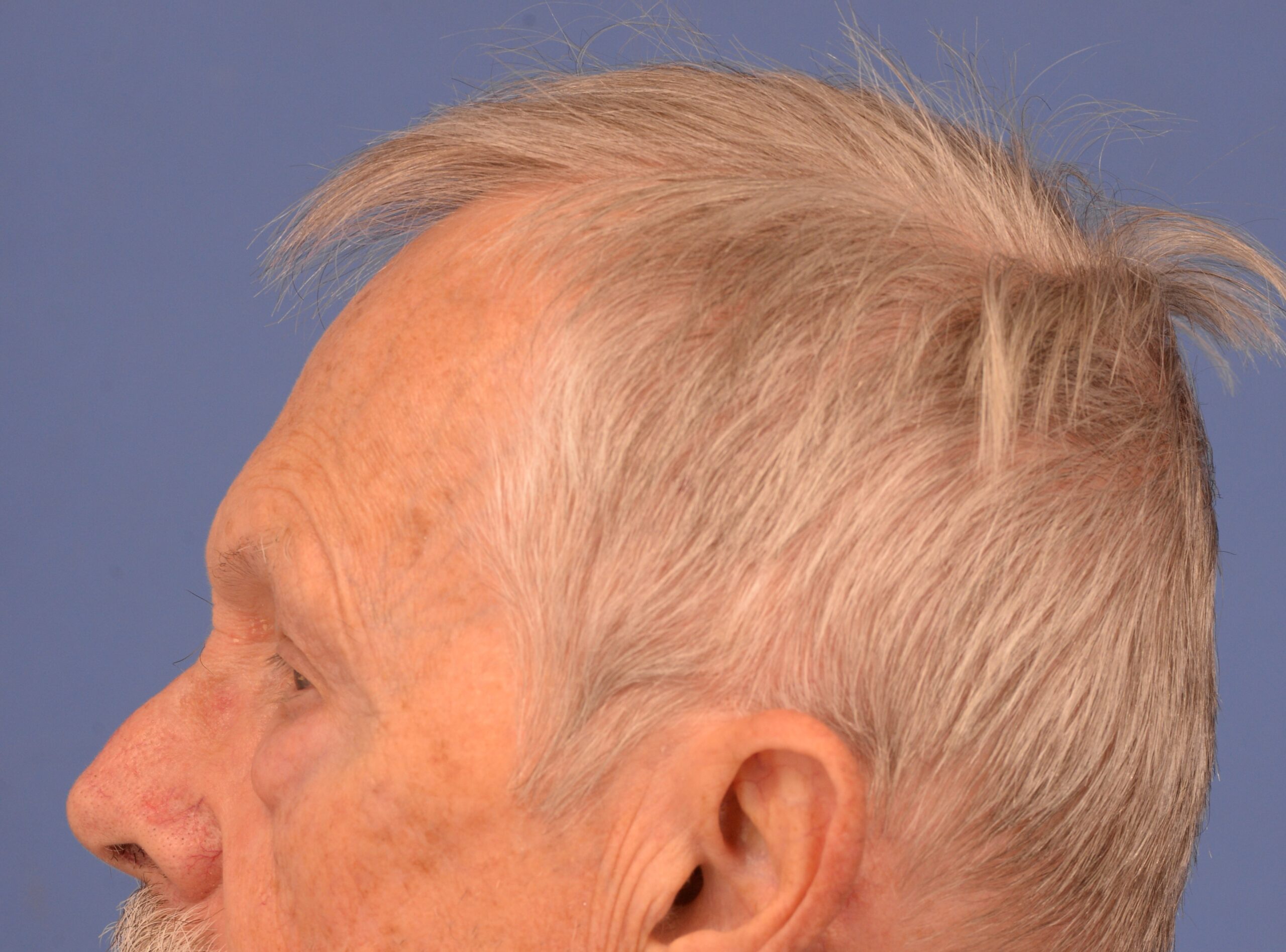 Case--7598 | Before Lower Blepharoplasty 5
