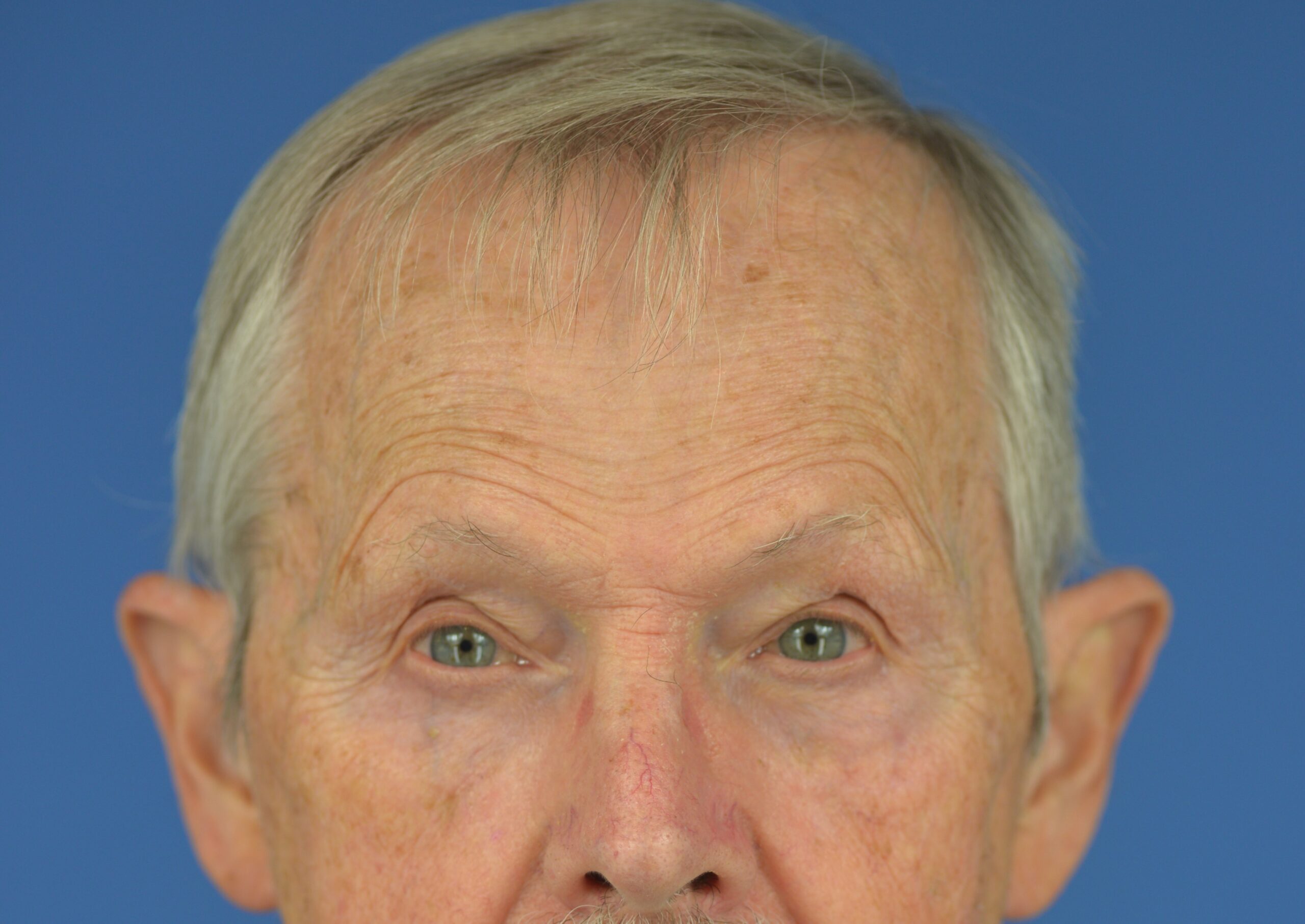 Case--7598 | After Lower Blepharoplasty 1