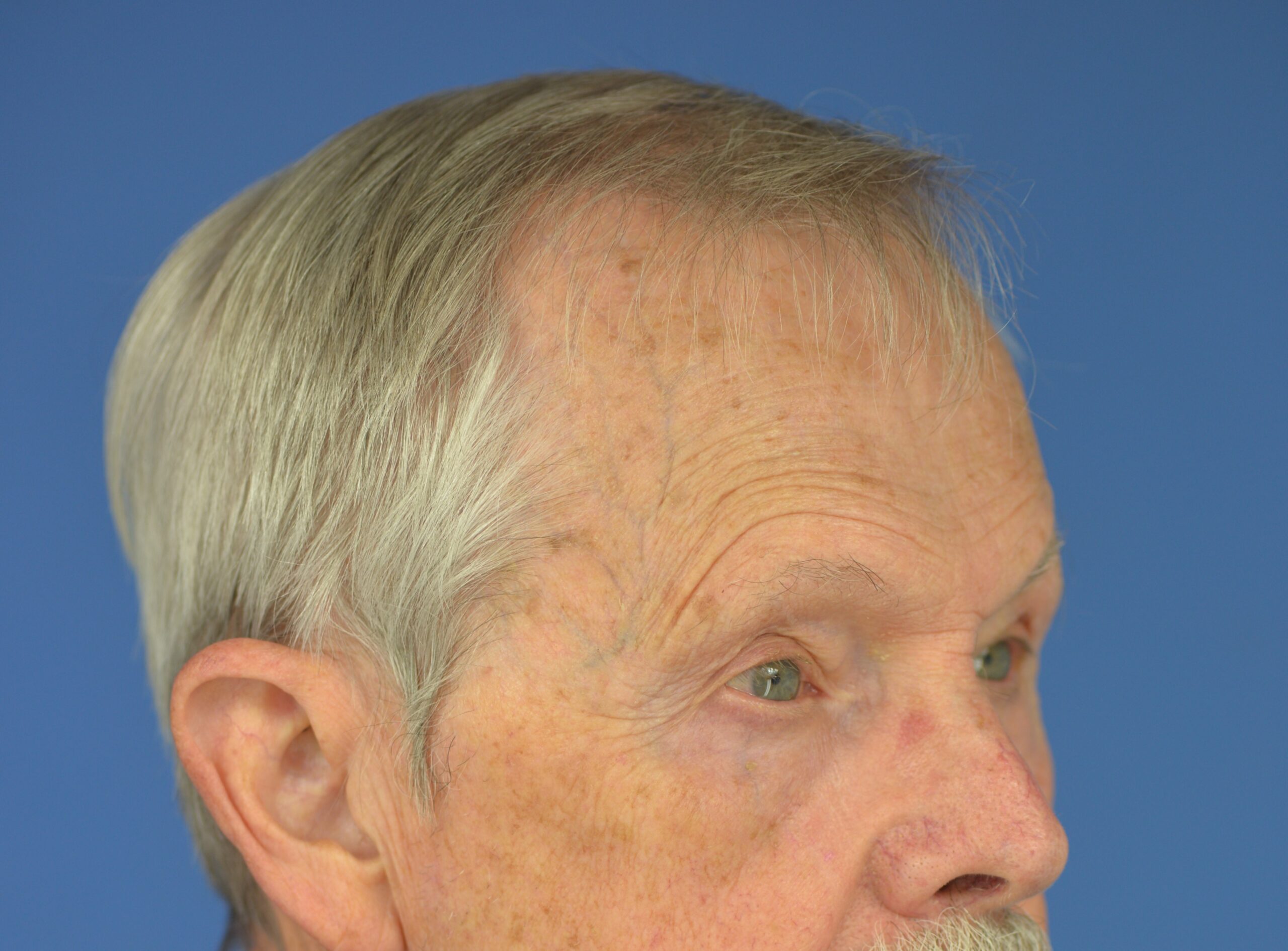 Case--7598 | After Lower Blepharoplasty 2