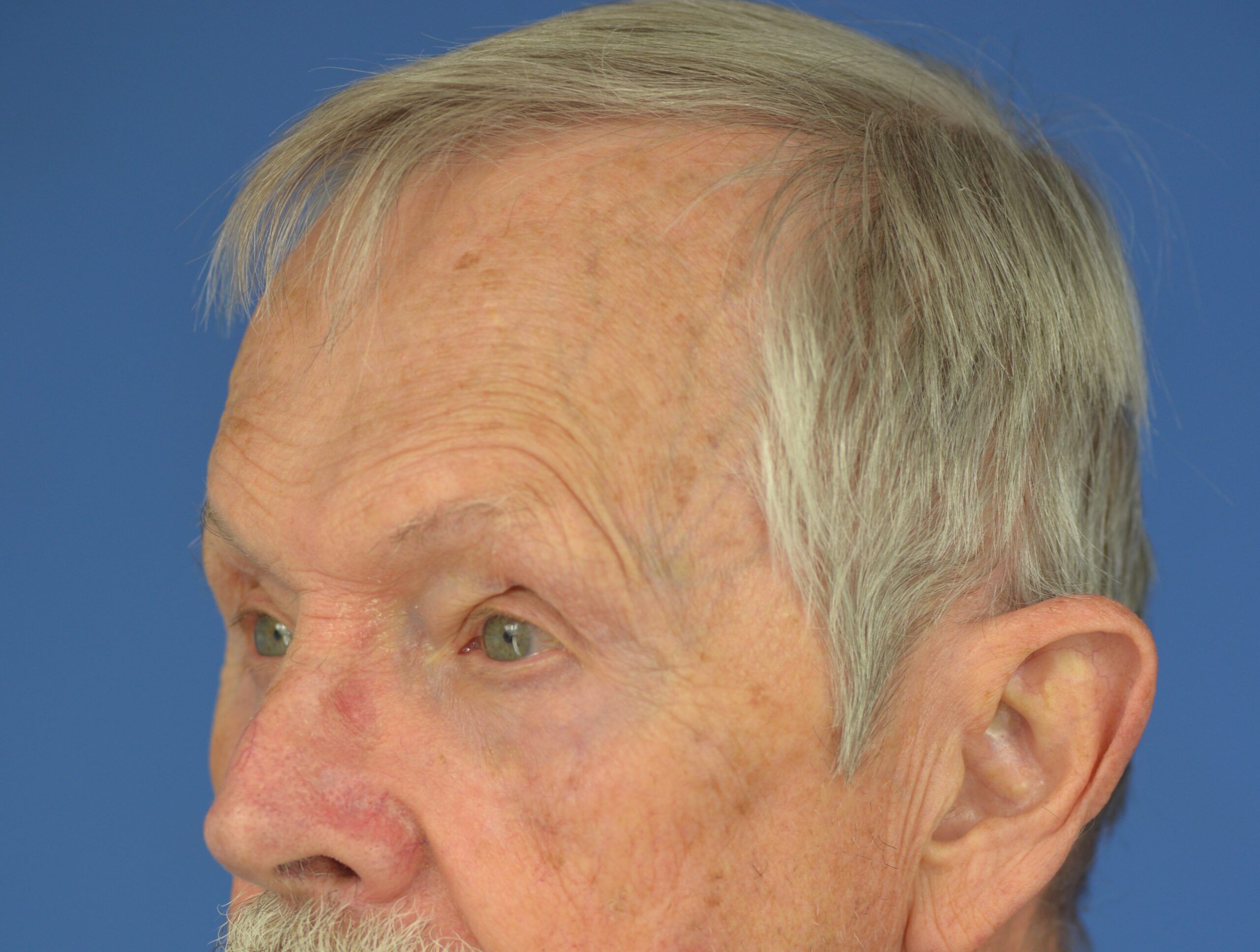 Case--7598 | After Lower Blepharoplasty 3