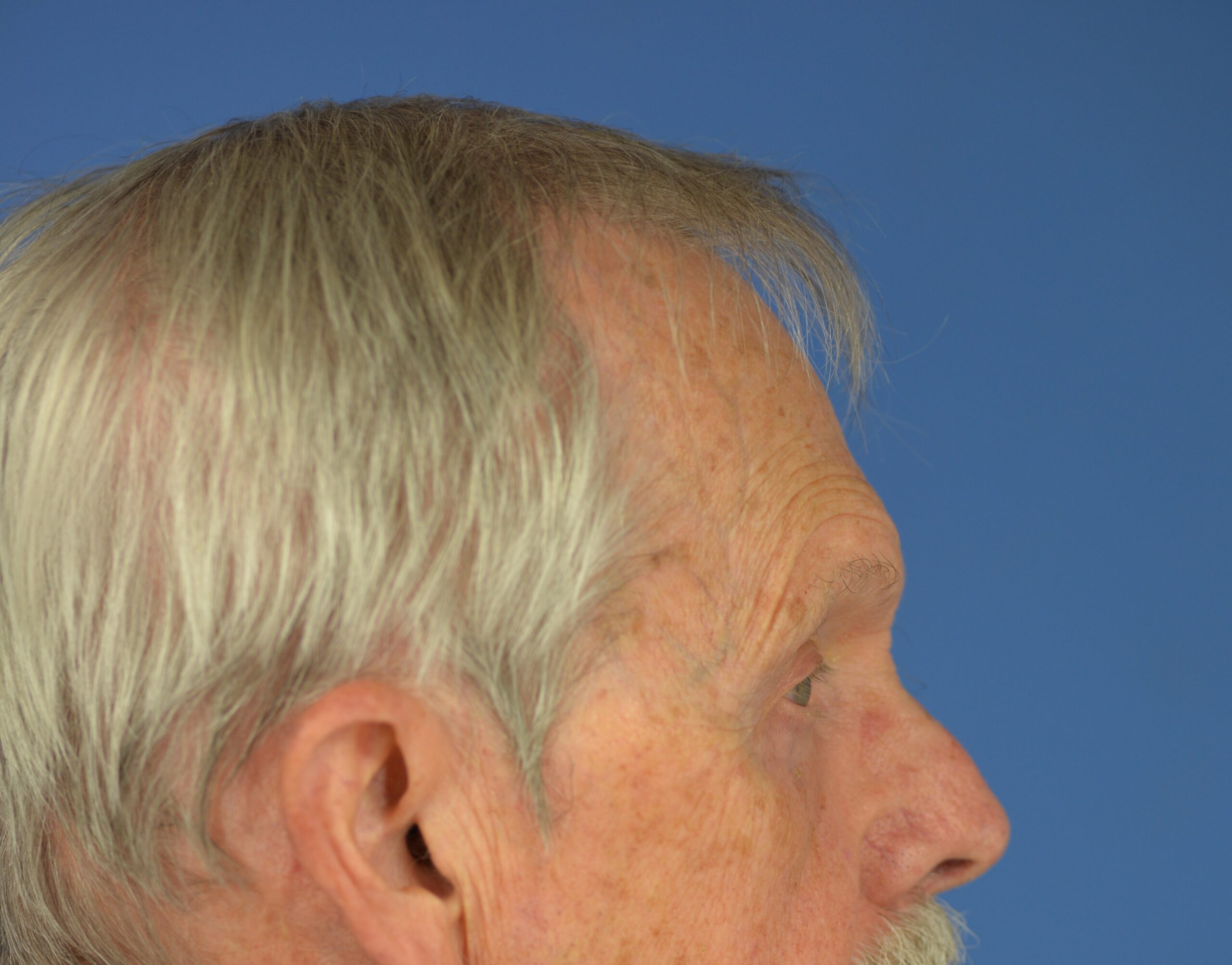 Case--7598 | After Lower Blepharoplasty 4
