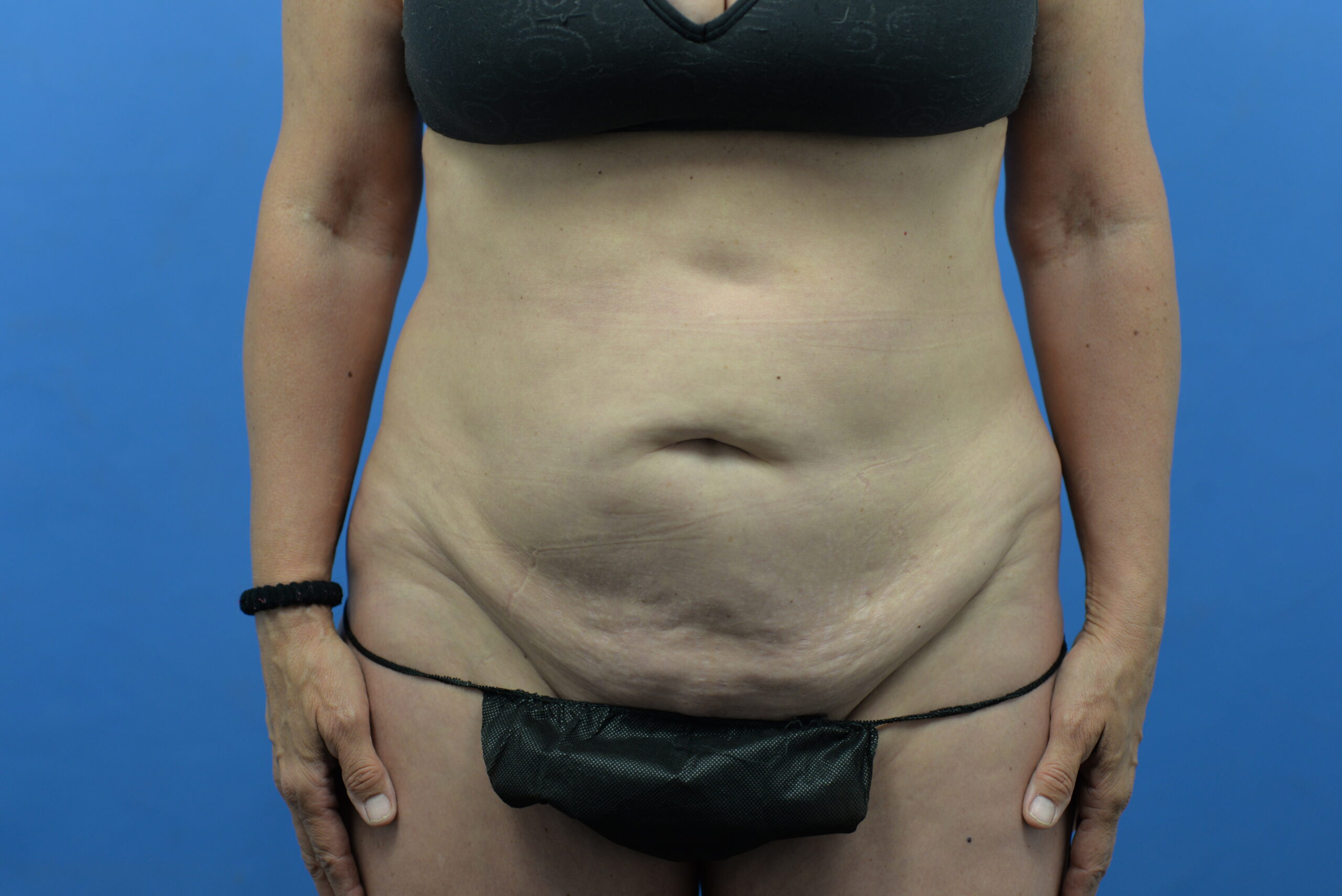 Case--3310 | Before Abdominoplasty With Liposuction 1