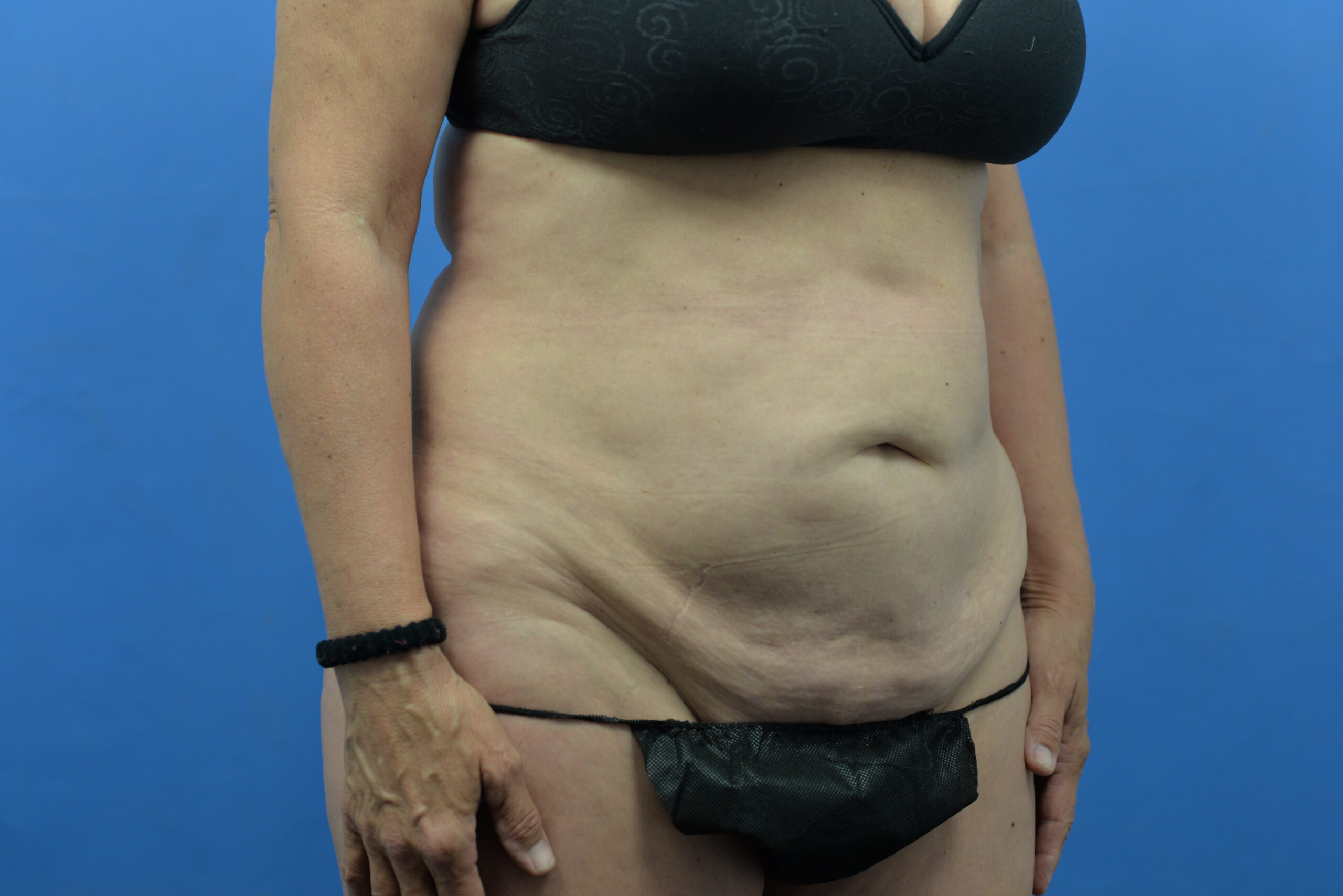 Case--3310 | Before Abdominoplasty With Liposuction 2