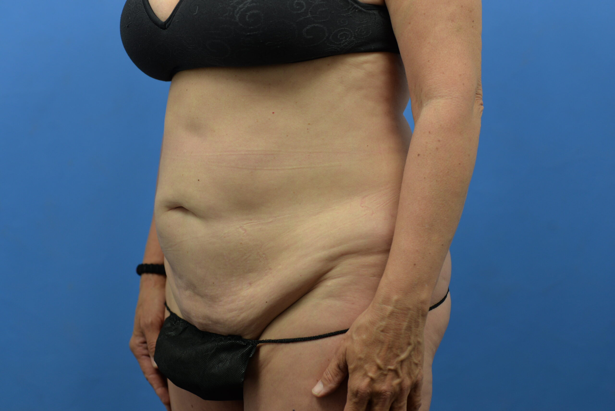 Case--3310 | Before Abdominoplasty With Liposuction 3