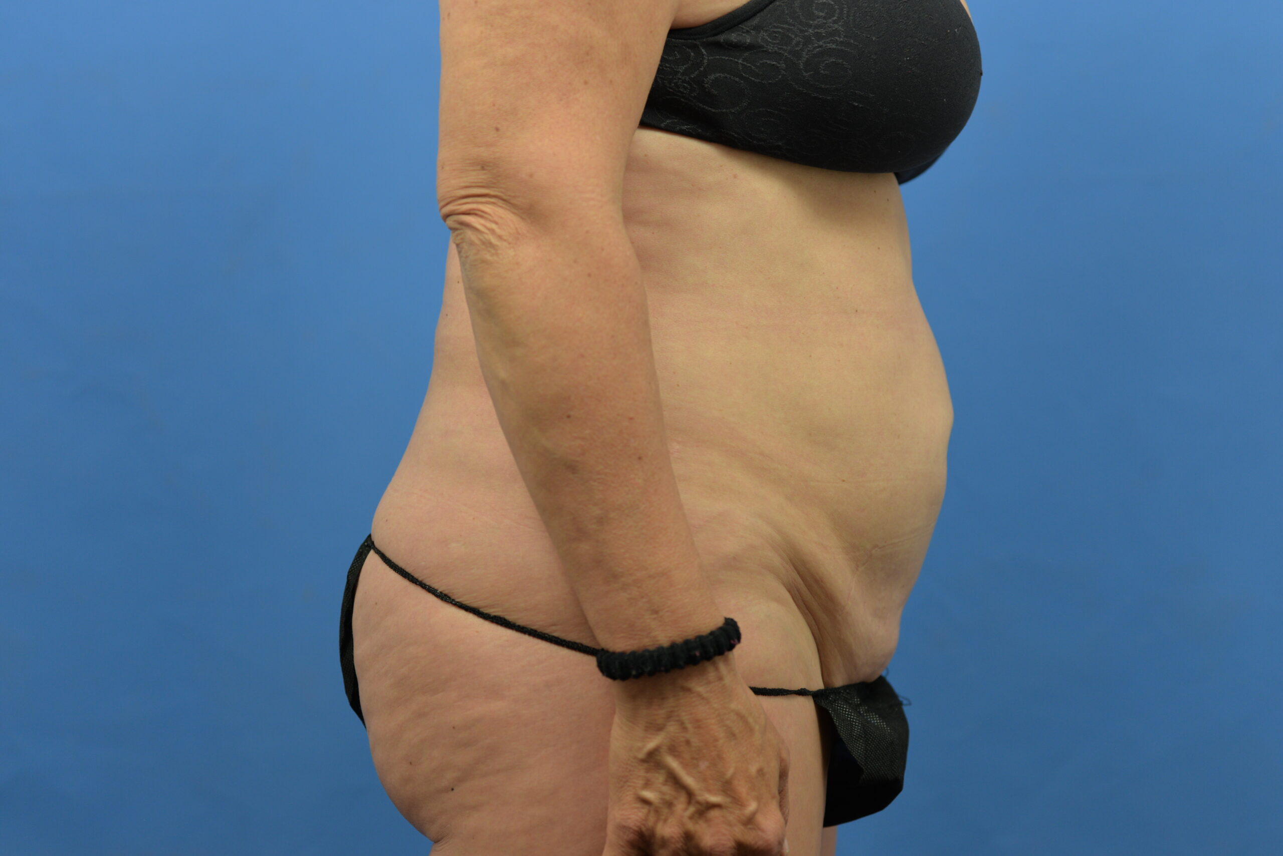 Case--3310 | Before Abdominoplasty With Liposuction 4