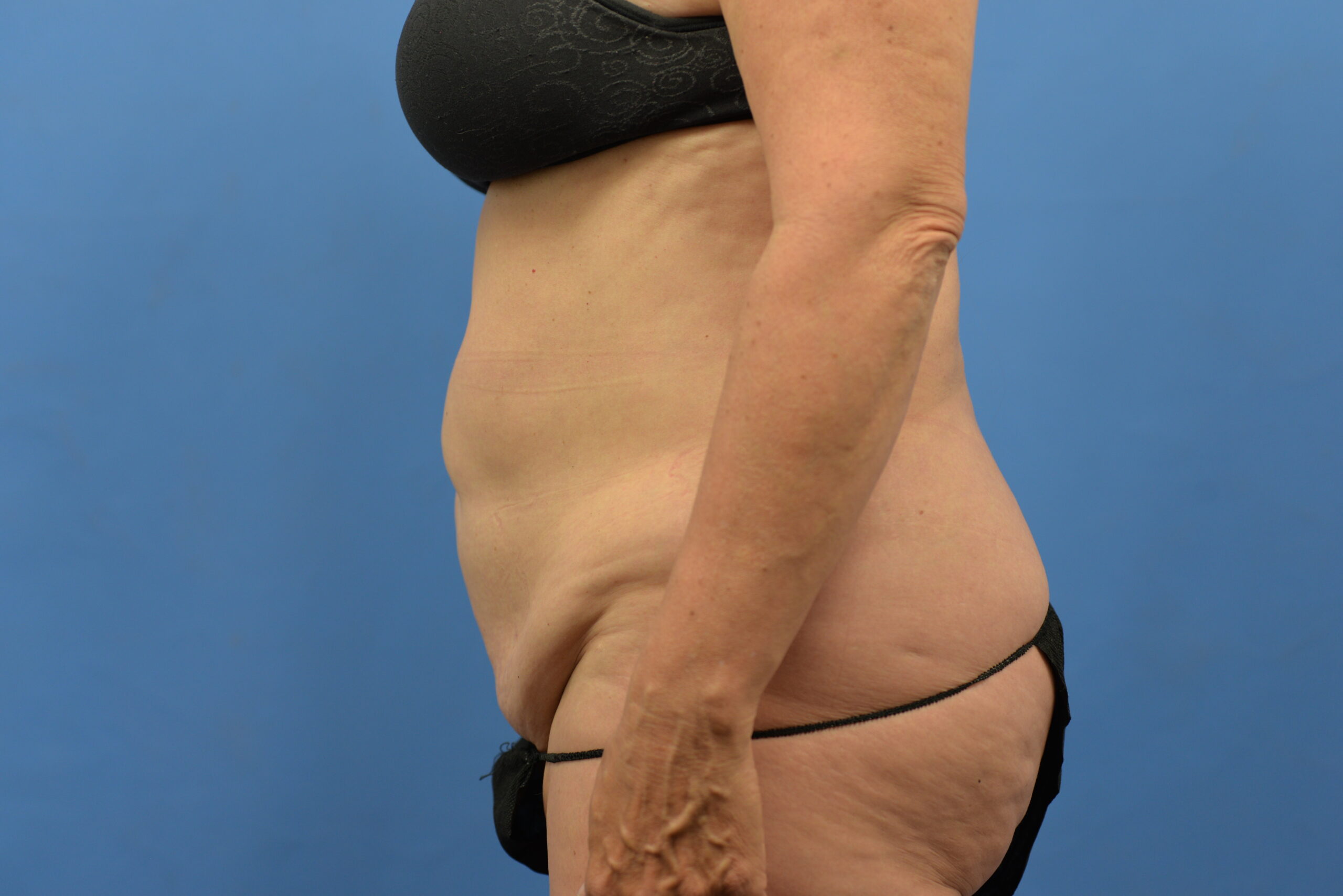 Case--3310 | Before Abdominoplasty With Liposuction 5