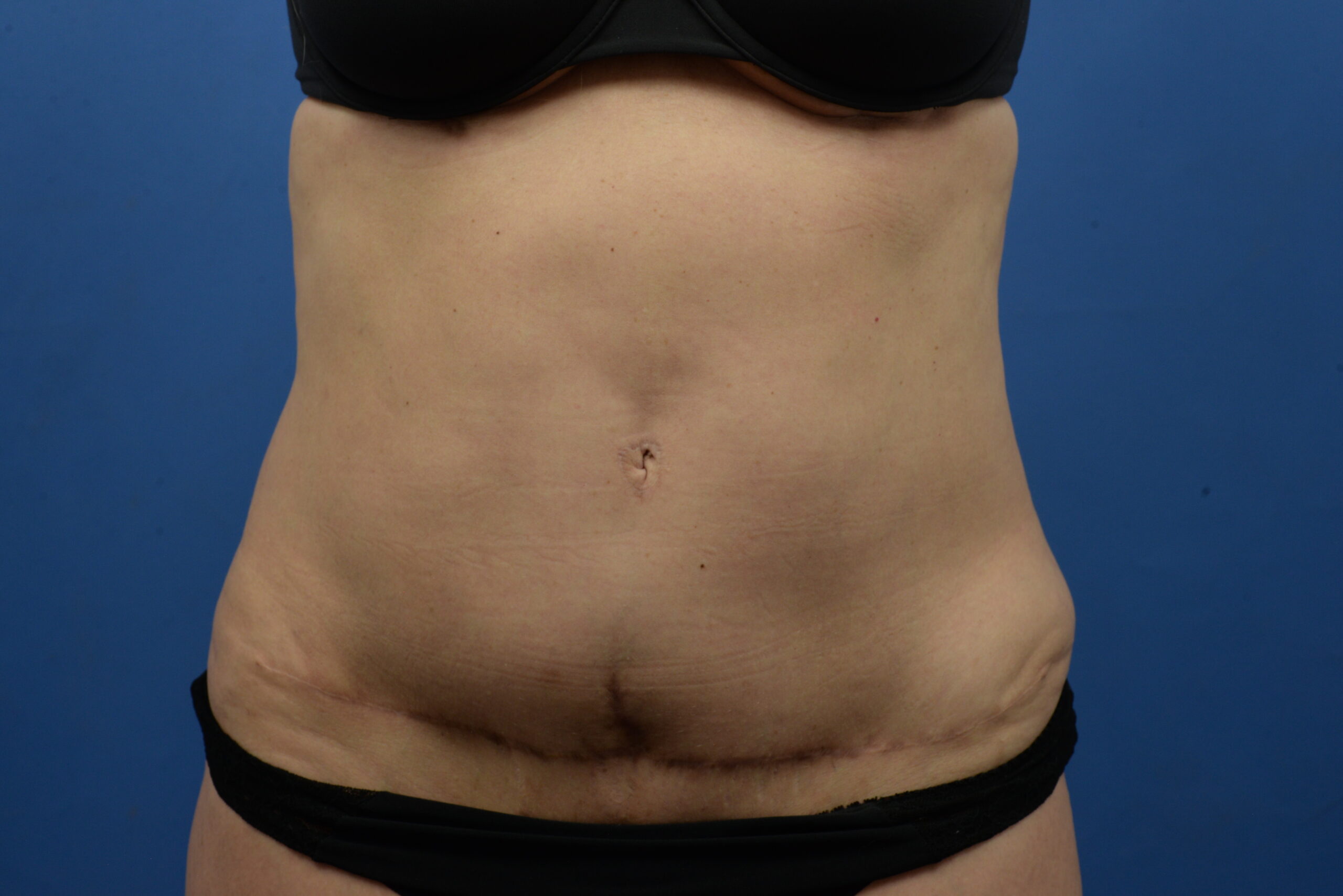 Case--3310 | After Abdominoplasty With Liposuction 1