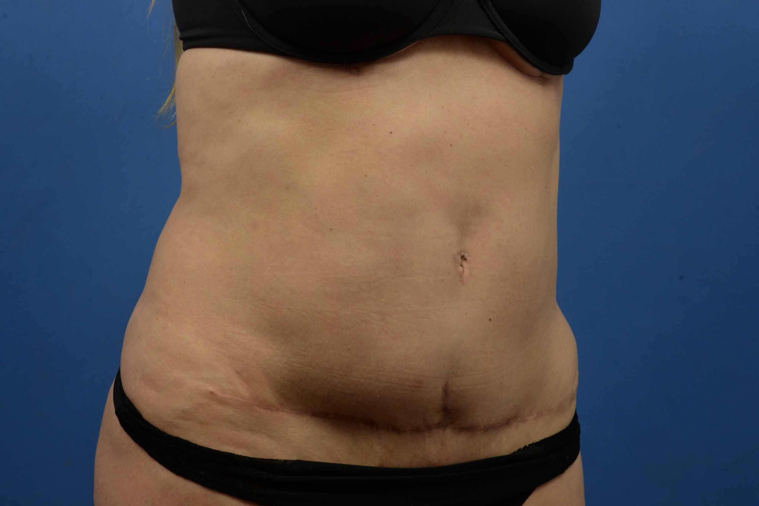 Case--3310 | After Abdominoplasty With Liposuction 2