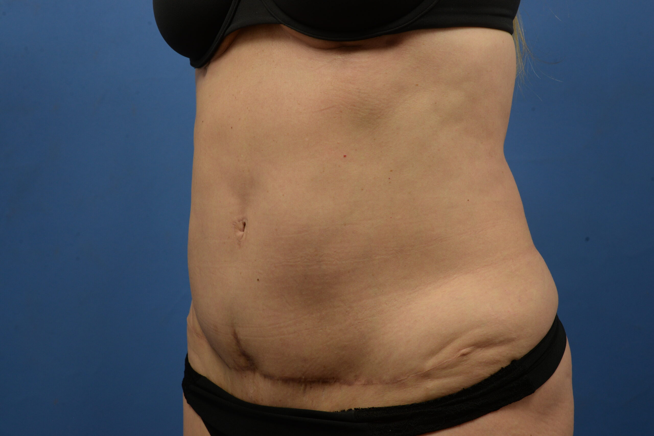 Case--3310 | After Abdominoplasty With Liposuction 3