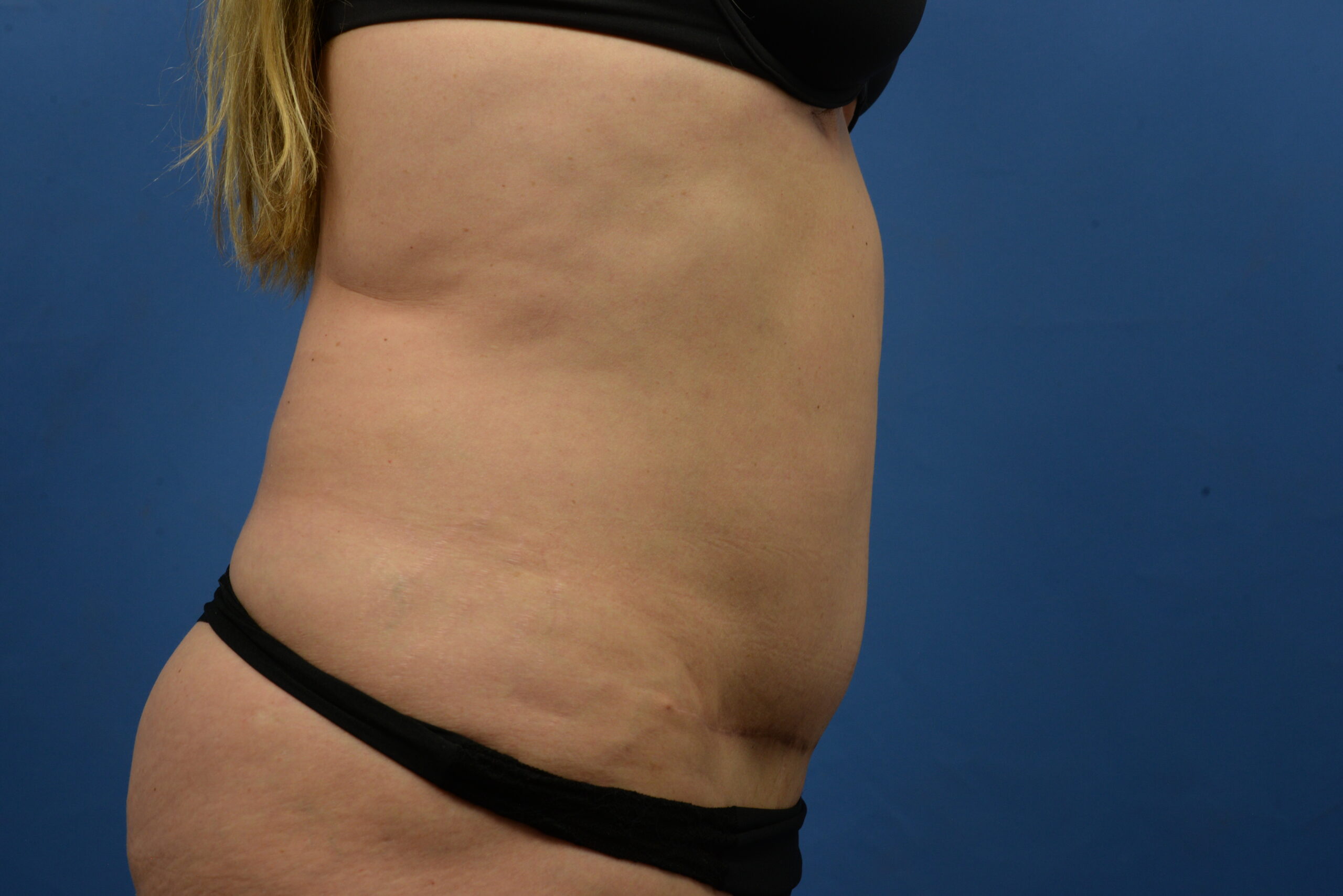 Case--3310 | After Abdominoplasty With Liposuction 4