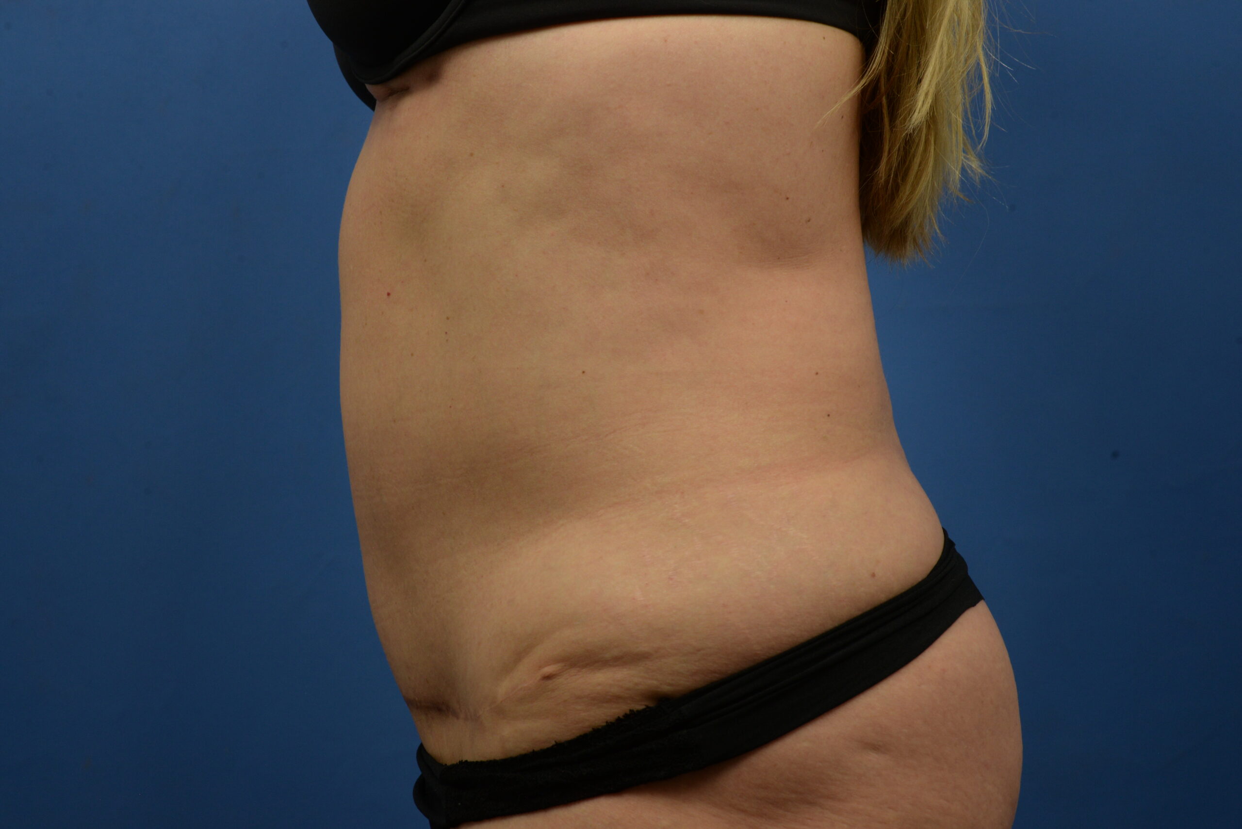 Case--3310 | After Abdominoplasty With Liposuction 5