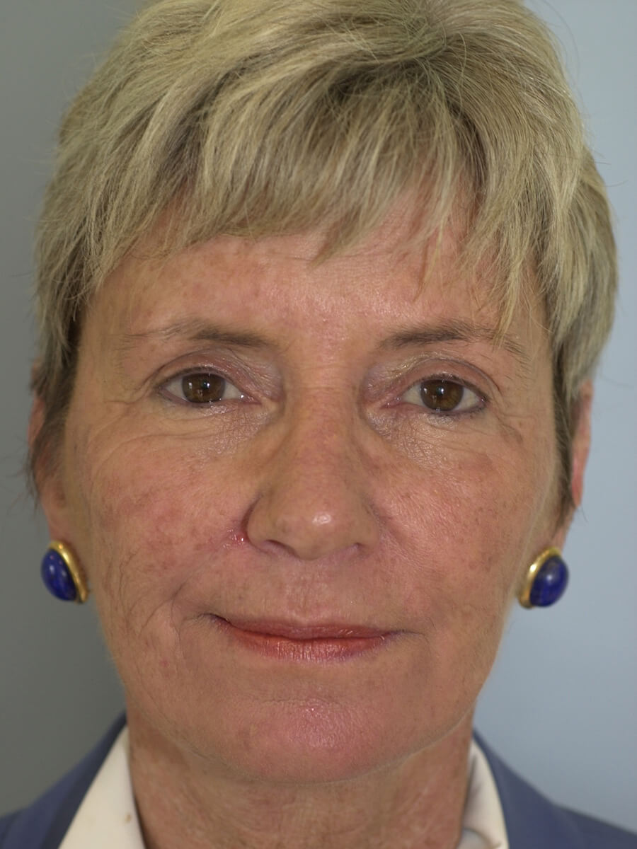 Case--3448 | After Face 1