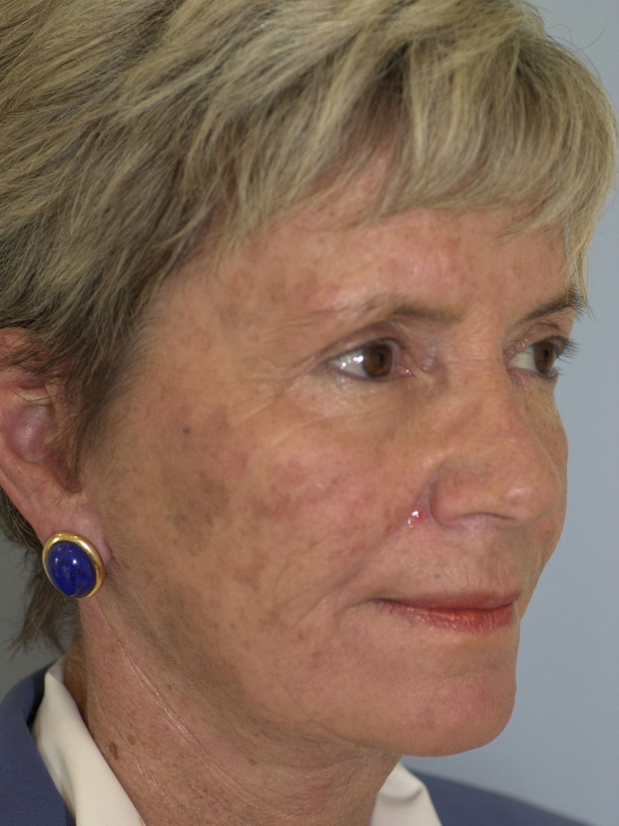 Case--3448 | After Face 2