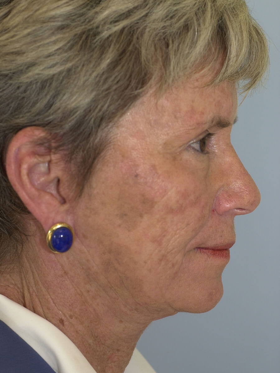 Case--3448 | After Face 3