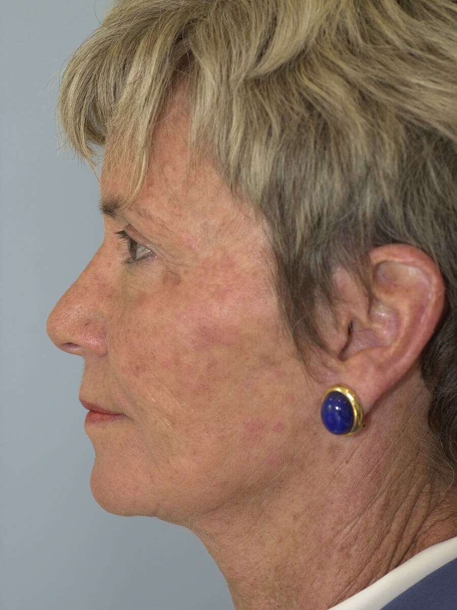 Case--3448 | After Face 4